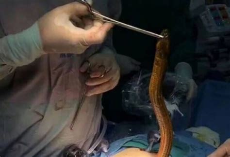 فيديو لحظة استخراج ثعبان بحر من جسد رجل جراءة نيوز