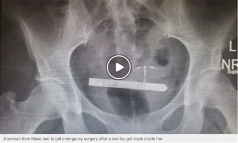 Woman Has Surgery To Remove Small Vibrator Stuck In Her
