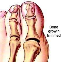 arthritic big toe joints  orlando orlando arthritic big toe joints arthritic big toe