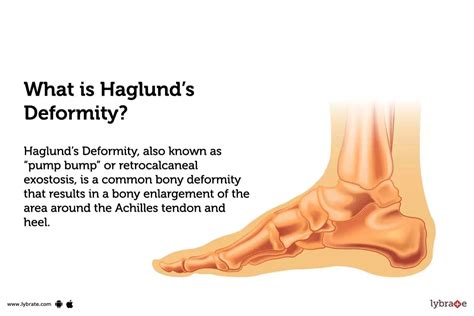 haglunds deformity  symptoms treatment  cost