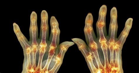 arthritis treatments relief    overcome  pain