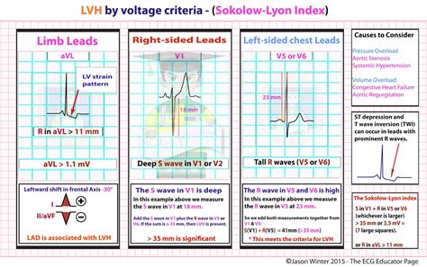 ecg educator blog lvh  voltage criteria sokolow lyon index