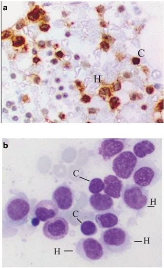 simultaneous diagnosis of hairy cell leukemia and chronic lymphocytic