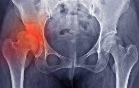 How To Treat Hip Pain Causes And Best Treatment Options In 2022