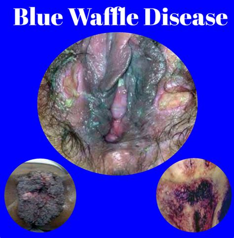 What Is Blue Wafflé Disease Pictured Public Health