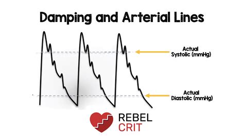 damping  arterial lines med tac international corp