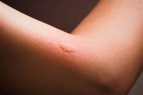 home remedies  treat  mosquito bite