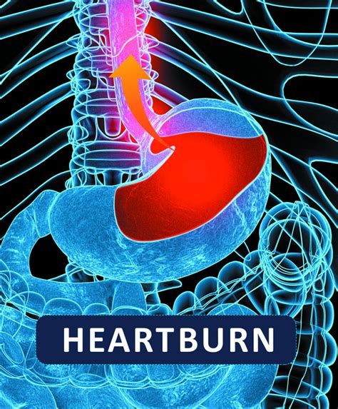heartburn feel   heart attack harvard health