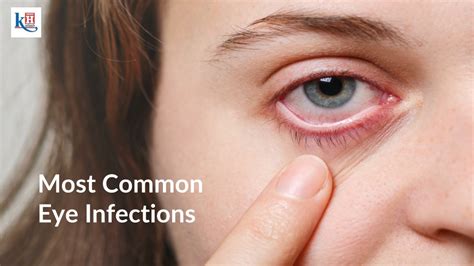 Ppt Discover Symptoms Damages And Prevention Tips For Eye Infections