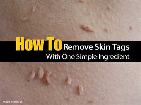 best 25 skin tag ideas on pinterest skin tag removal mole removal at home and remove skin