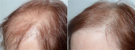Hair Transplants For Women Pictures Miami Fl Paciente 74079