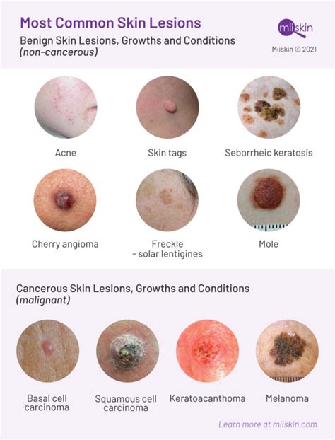 skin lesions types pictures prevention