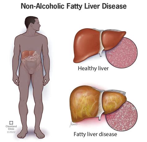 Early Signs Of Non Alcoholic Fatty Liver Disease Fundahigado America