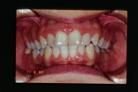 extração de quatro pré molares cesar bigarella