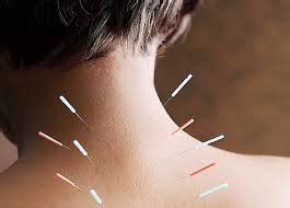 coquitlam acupuncture harmony physiotherapy