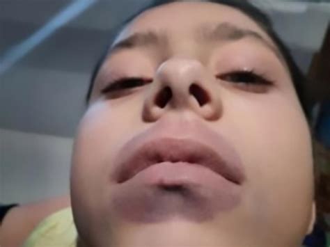 kylie jenner lip challenge leads to girl s shock diagnosis 7news