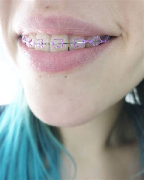 pin by evil h on braces dental braces teeth braces ceramic braces