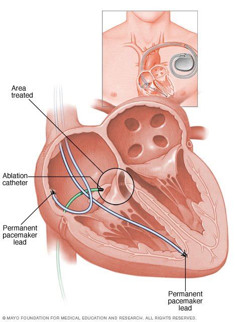 Atrial Fibrillation Disease Reference Guide