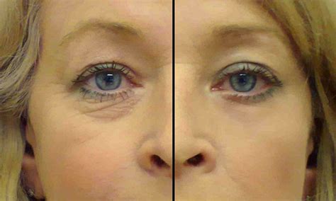 eye secrets anti wrinkle patch      years younger   mins daily mail