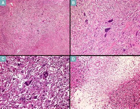 Solitary Fibrous Tumor With Atypical Features Of The