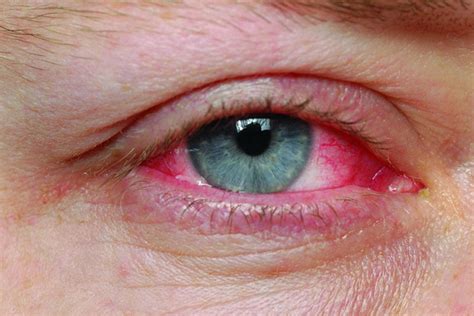 pink eye symptoms  types treatment   relief