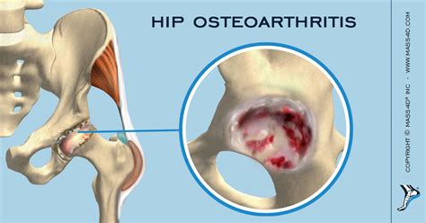 understanding hip osteoarthritis massd foot orthotics