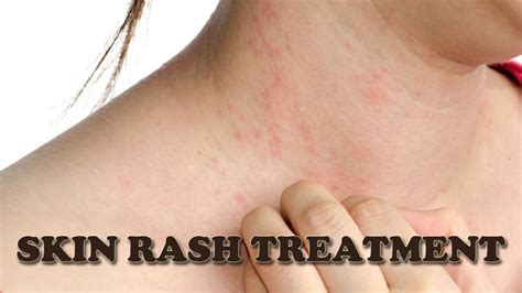 Skin Rash Treatment How To Treat Itchy Skin Rash