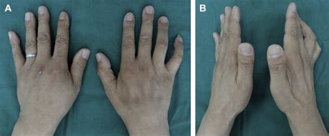 Entrapment Neuropathy Of The Wrist Forearm And Elbow