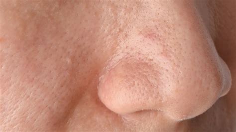 sebaceous filaments about vs blackheads why to leave alone