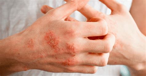 eczema treatment 13 home remedies for eczema dr axe
