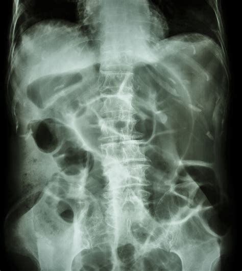 intestinal obstruction overview  symptoms treatment