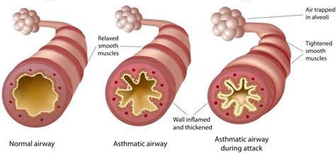 approach  asthma   ed canadiem