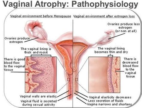 vaginal dryness and vaginal atrophy you are not alone body menopause diet post menopause