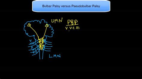 bulbar palsy progressive paralysis bulbar fazio londe syndrome