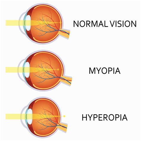 astigmatism and short sightedness astigmatism glaucoma