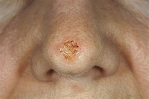 Risk For Basal Squamous Cell Carcinoma Linked To Hydrochlorothiazide