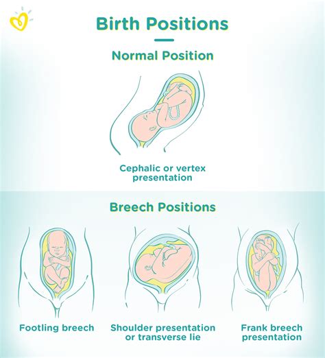 Vertex Position Fetal Position In