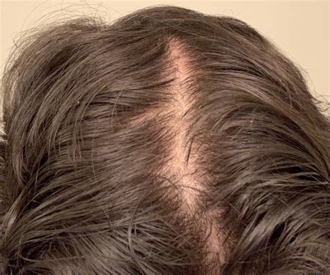 normal   scalp  hair allistairkelly