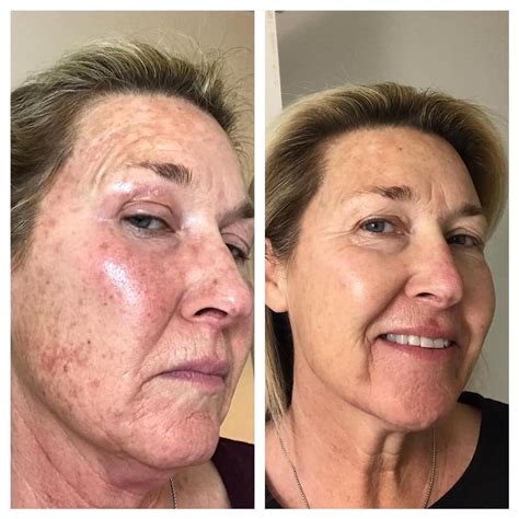 elaine brennan  glowing micro peel  hurst euless  bedford