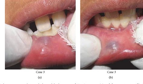 figure   nonsurgical management  oral mucocele  intralesional