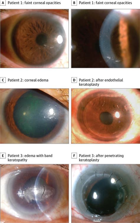 Toxic Keratopathy Following The Use Of Alcohol Containing Antiseptics