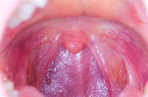 throat cancer s link to oral sex what you should know