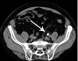 Kidney Stone In Ureter Photos