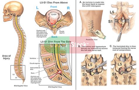 l5 s1 lumbar disc herniation with surgical discectomy and decompression