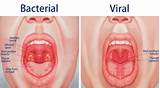 Images of Virus Sore Throat Fever Headache