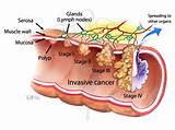 Images of Cancer Colon Stages