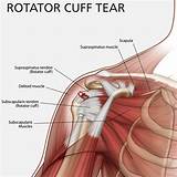 Rotator Cuff Injury Images
