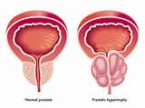 Enlarged Prostate Cancer