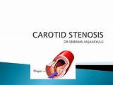 Pictures of Carotid Artery Stenosis