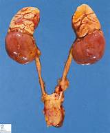 Pictures of Tumor On Adrenals
